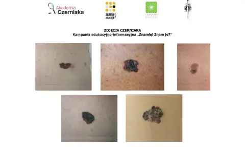 Różne rodzaje znamion i czerniaków. Kampania edukacyjna "Znamię! Znam je?".