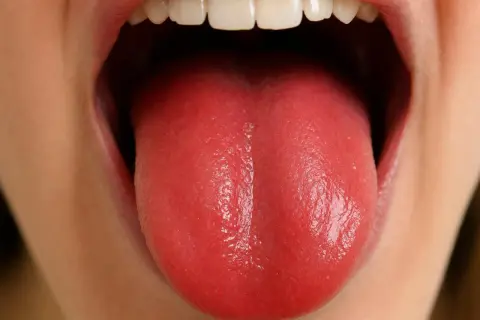 Lingua rossa e liscia, possibile sintomo di carenza vitamina b12.