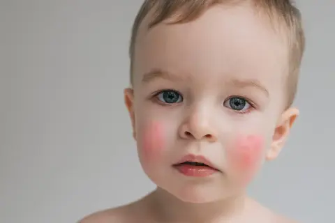 Uroczy chłopiec z rumianymi policzkami, być może z powodu nietolerancji białka mleka krowiego.