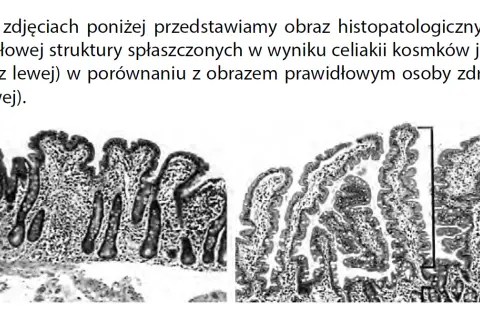 Celiakia jaki lekarz - jak nie popełnić błędu w diagnozie?