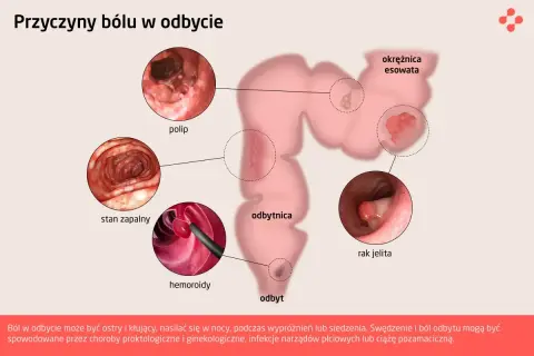 Ilustracja przedstawia przyczyny bólu w odbycie: polipy, stan zapalny, hemoroidy, raka jelita. Dyschezja może być objawem tych schorzeń.