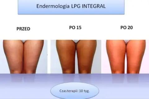 Endermologia: dla kogo? Kiedy warto, a kiedy unikać zabiegu?