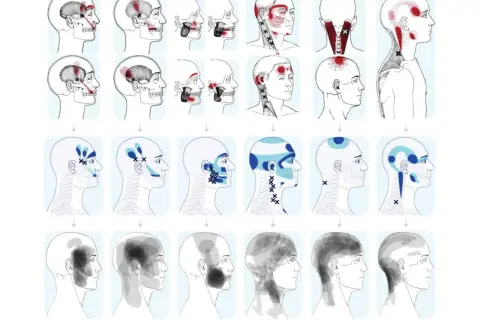 Mappa dolore riferito: illustrazioni di teste umane con aree di dolore evidenziate in rosso e blu, che mostrano la distribuzione del dolore riferito da specifici muscoli.