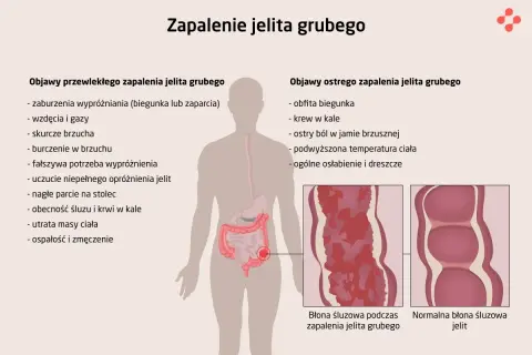 Ilustracja przedstawia objawy zapalenia jelita grubego, w tym wrzodziejące zmiany błony śluzowej jelita.