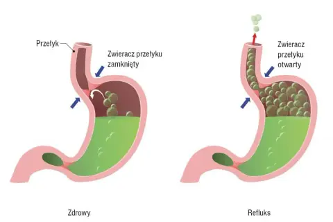 Zdrowy żołądek z zamkniętym zwieraczem przełyku vs. refluks, gdzie otwarty zwieracz pozwala treści żołądkowej cofnąć się do przełyku.