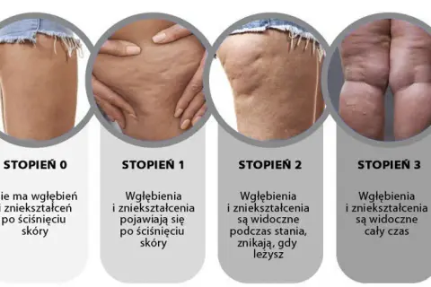 Cellulit na udach i pośladkach: skuteczne metody i zabiegi