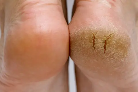 Tiefer Riss in der Ferse? Hausmittel können helfen, die Haut zu regenerieren und Schmerzen zu lindern.