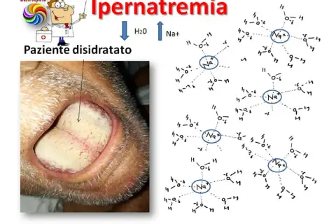 Lingua: Italiano

Ipernatremia: paziente disidratato con lingua secca e patinata, indicativo di sodio alto. Le molecole di Na+ circondate da H2O illustrano la condizione.