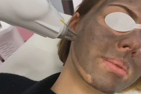 Zabieg laserowy z maską węglową. Skóra twarzy pokryta ciemną maską, oczy osłonięte.