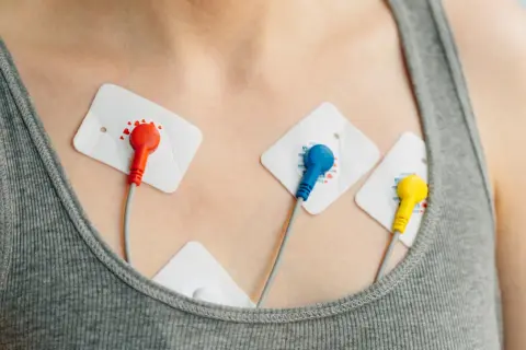 Elektrody EKG na klatce piersiowej, monitorujące pracę serca w celu wykrycia arytmii.