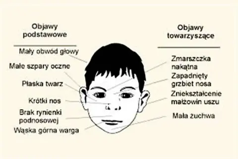 Ilustracja przedstawia twarz dziecka z zaznaczonymi objawami: mały obwód głowy, płaska twarz, krótki nos, wąska górna warga, zmarszczka nakątna, zapadnięty grzbiet nosa, zniekształcenie małżowin uszu.
