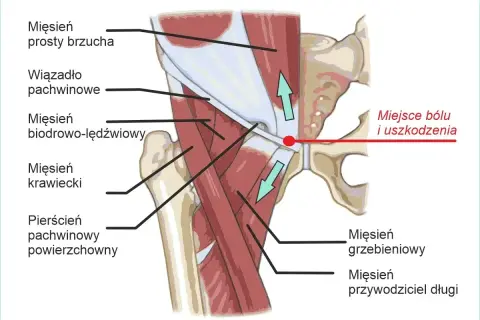 Anatomia pachwiny z zaznaczonym miejscem bólu i uszkodzenia. Ilustracja pokazuje mięśnie brzucha, biodrowo-lędźwiowy, krawiecki oraz pierścień pachwinowy.