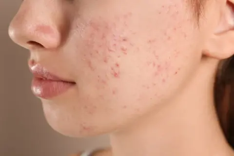 Primer plano de una mejilla con granos en la cara, mostrando la textura de la piel y las imperfecciones.