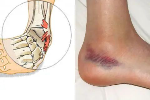 Illustrazione anatomica dei legamenti della caviglia e foto di una caviglia con ematoma, indicativi di un trauma.