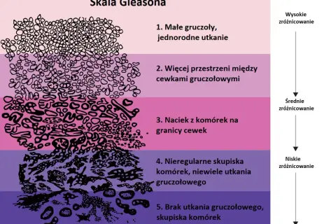 Skala Gleasona ilustruje wyniki biopsji prostaty, pokazując stopnie zróżnicowania komórek od 1 do 5.
