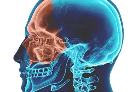 Anatomia del cranio in sezione, evidenziando i seni mascellari in arancione. Utile per comprendere la sinusite mascellare odontogena e i suoi rimedi.