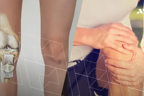 Anatomia kolana po lewej, po prawej osoba trzymająca się za bolące kolano.