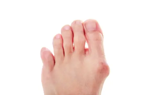 Piede con alluce valgo e dita leggermente piegate, suggerimenti su come raddrizzare le dita dei piedi.