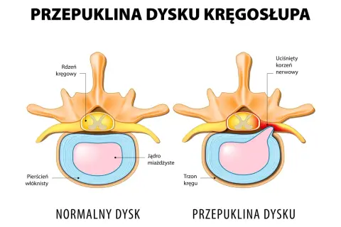 Porównanie zdrowego i przepukliny dysku kręgosłupa. Widoczny ucisk na korzeń nerwowy w przypadku przepukliny.