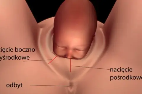 Jak długo boli nacięcie krocza po porodzie? Czas gojenia i ból.