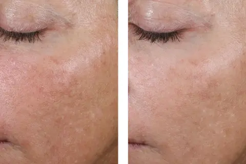 Comparaison avant/après : peau avec rougeurs et irrégularités, puis peau plus lisse et uniforme, peut-être grâce au retinol ou acide hyaluronique.