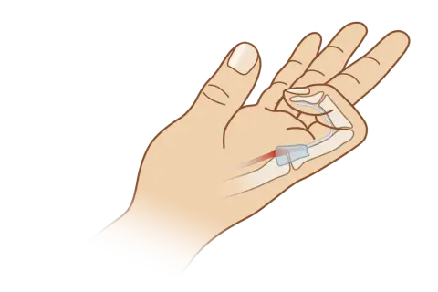 Illustration einer Hand, die zeigt, wie die Finger schmerzen beim Beugen durch eine Entzündung im Sehnenbereich.