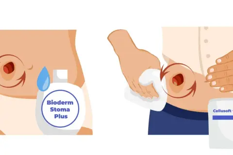Illustration montrant le nettoyage d'une stomie avec une lingette et un produit, avant de poser une nouvelle poche de stomie pleine.
