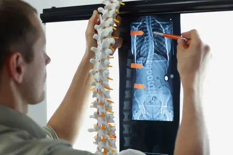 Un médecin examine une radiographie montrant une scoliose. La courbure vertébrale peut affecter l'espérance de vie.