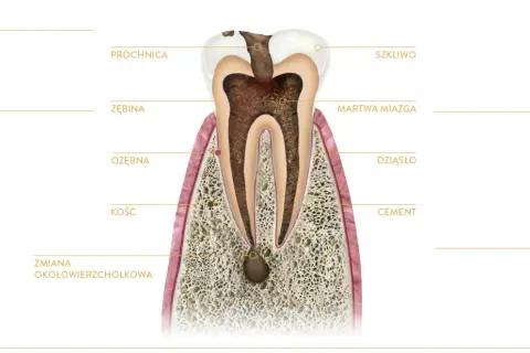 Przekrój zęba z widoczną próchnicą, martwą miazgą i zmianą okołowierzchołkową. To ilustracja wyjaśniająca, endodoncja co to jest.