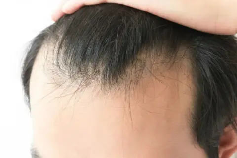 Primer plano de la línea del cabello de un hombre, mostrando adelgazamiento y entradas. Una mano toca la parte superior de la cabeza, quizás preguntándose porque los hombres se quedan calvos.