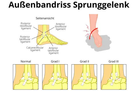 Illustration zeigt einen Bänderriss am Sprunggelenk, mit Fokus auf das ligamentum fibulotalare anterius und verschiedene Schweregrade.
