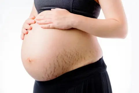 Brzuch ciężarnej kobiety z widocznymi rozstępami. Delikatne linie na skórze świadczą o przemianach zachodzących w ciele.