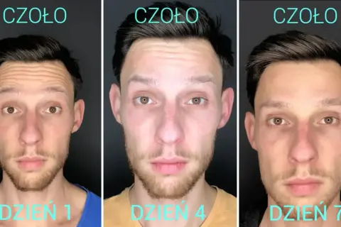 Trzy zdjęcia mężczyzny pokazujące efekt botoksu na czole: dzień 1 (zmarszczki), dzień 4 i 7 (gładka skóra).