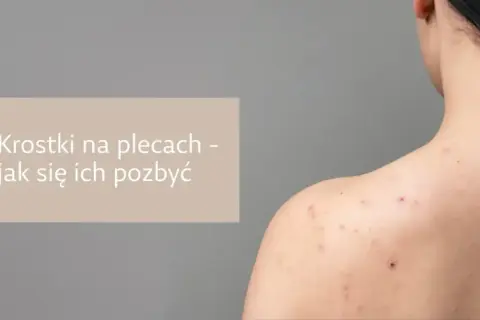 Widok pleców z pryszczami. Dowiedz się, od czego mogą być pryszcze na plecach i jak się ich pozbyć.