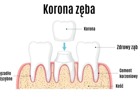 Ilustracja pokazuje odbudowę korony zęba. Nowa korona jest umieszczana na przygotowanym zębie, zapewniając mu pełną funkcjonalność i estetykę.