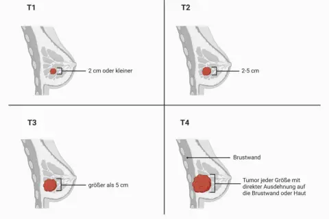 Veranschaulicht die **Mammakarzinom Stadien** T1 (kleiner als 2 cm), T2 (2-5 cm), T3 (größer als 5 cm) und T4 (Ausdehnung auf Brustwand/Haut).