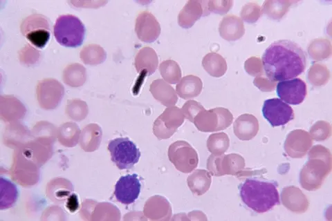 Blutausstrich mit Lymphozyten und Erythrozyten. Die Anzahl der Lymphozyten kann Hinweise auf die cll lebenserwartung geben.