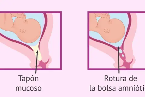 Ilustración comparativa: tapón mucoso y rotura de la bolsa amniótica, señales del parto en la semana 37.