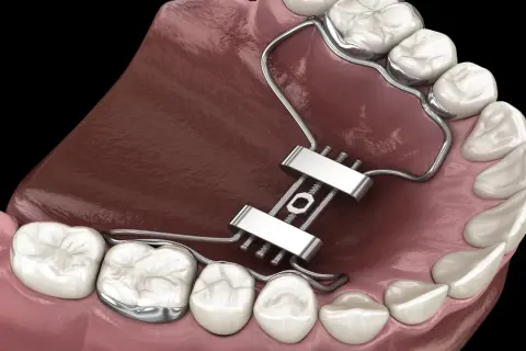 Dettaglio di un espansore palatale metallico applicato ai denti superiori per correggere la mascella.