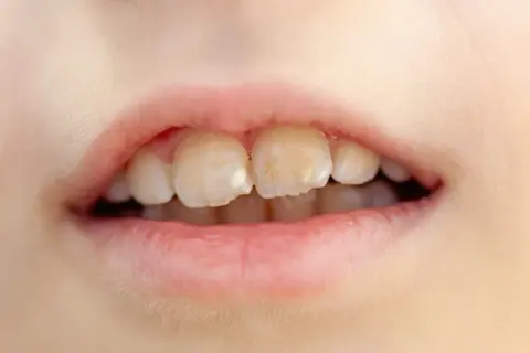 Jak wyleczyć próchnicę bez dentysty? Co możesz, a czego nie!