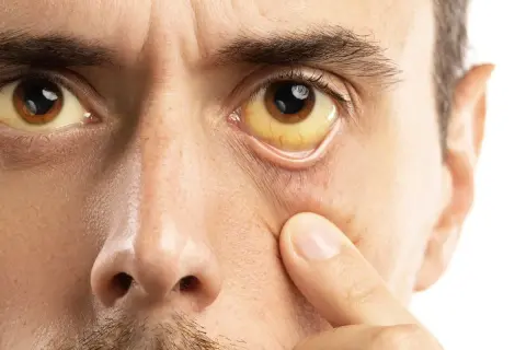 Zespół Gilberta a psychika: Zmęczenie, lęk, mgła mózgowa?