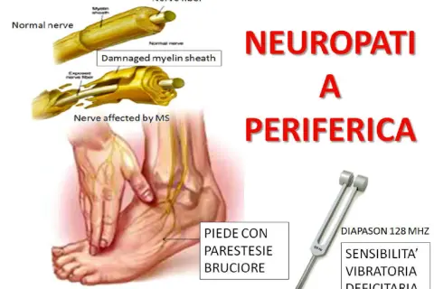 Immagine illustra cosa vuol dire neuropatia periferica: nervi sani e danneggiati, un piede con parestesie e bruciore, e un diapason per testare la sensibilità vibratoria.