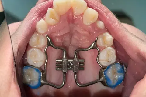 Espansore palato bambini costo: apparecchio ortodontico per allargare il palato, con placchette blu sui molari.