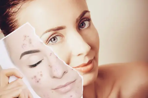 Mujer muestra un trozo de piel con acné, comparándola con su rostro, preguntándose cuánto tarda en regenerarse la piel.