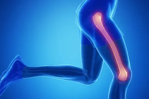 Anatomia nogi z podświetloną kością udową, sugerującą złamanie kości udowej.