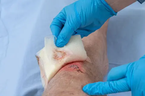 Blaue Handschuhe bedecken eine genähte, offene Wunde am Knie, die mit Gaze abgetupft wird.
