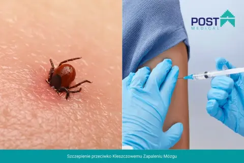 Kleszczowe zapalenie mózgu: szczepionka ile dawek? Widok kleszcza na skórze i podanie szczepionki.