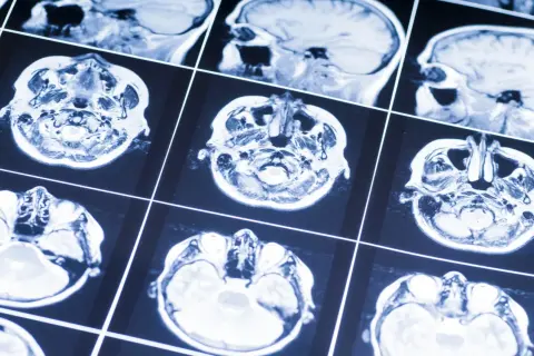 Przekroje mózgu na rezonansie magnetycznym. Obraz może pomóc w diagnostyce oponiak objawy, analizując strukturę tkanki mózgowej.