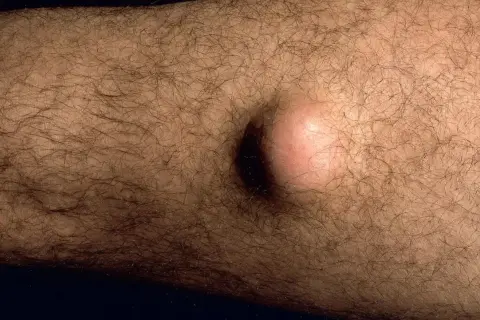 Ein gutartiger Tumor, eine helle, runde Beule, hebt sich auf der behaarten Haut eines Arms ab.