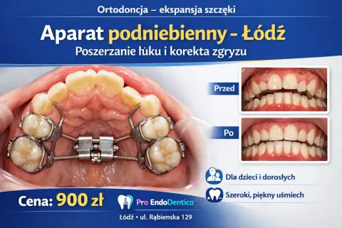 Aparat podniebienny poszerza łuk zębowy, korygując zgryz. Zdjęcia "przed" i "po" pokazują efekty leczenia.